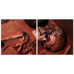 Skelett med Frakturer - Tavla i Tv&aring; delar